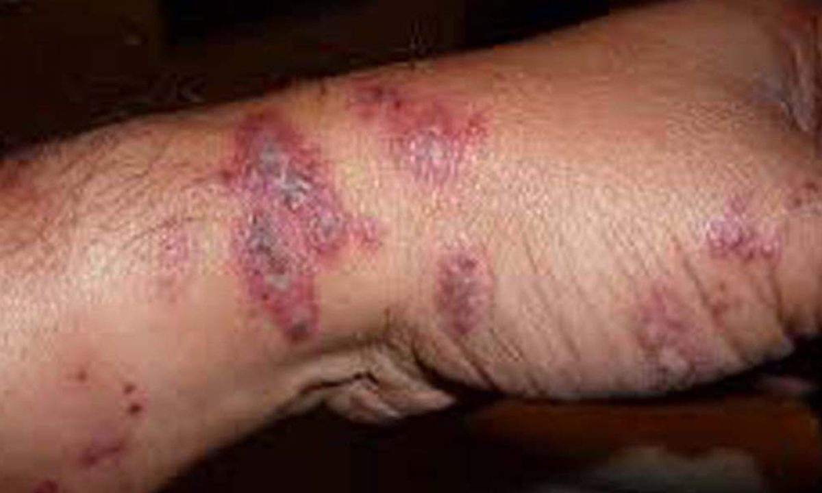 After Covid19 China Reports Suspected Bubonic Plague Case Alert Sounded