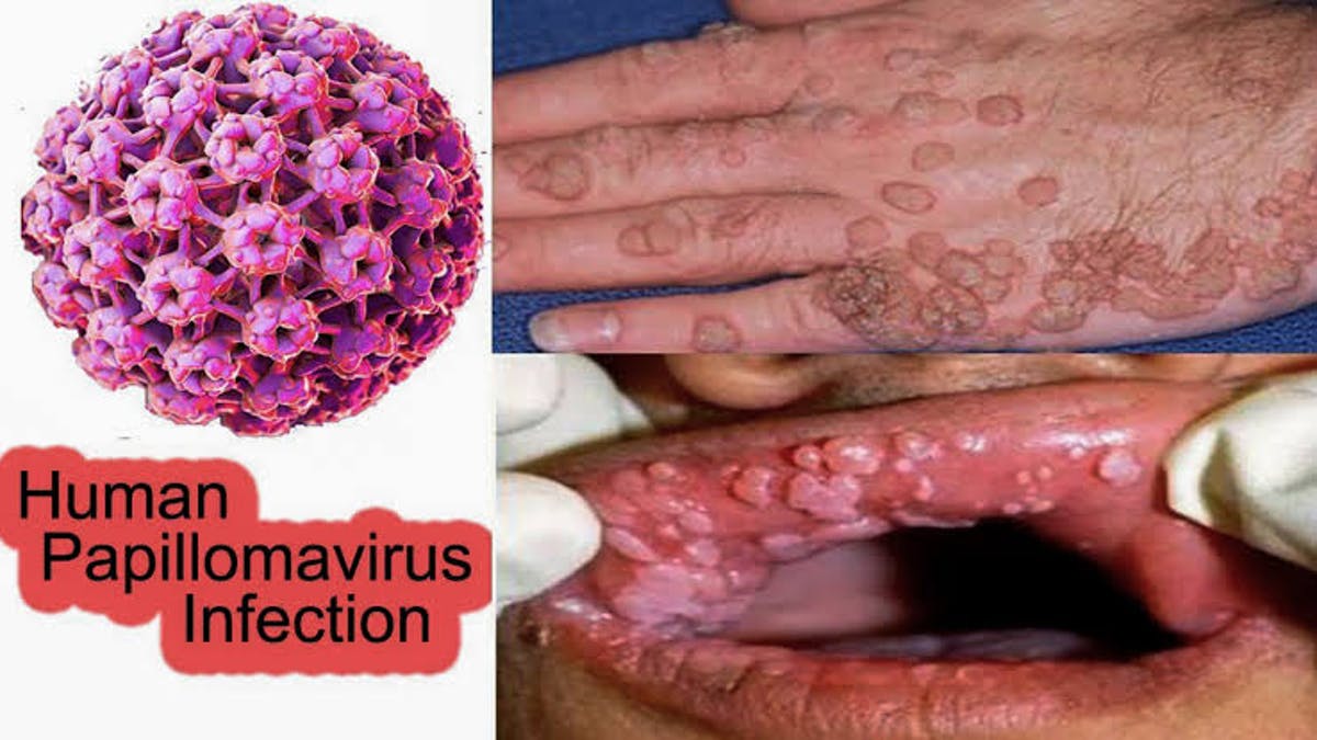 what is human papilloma virus hpv))