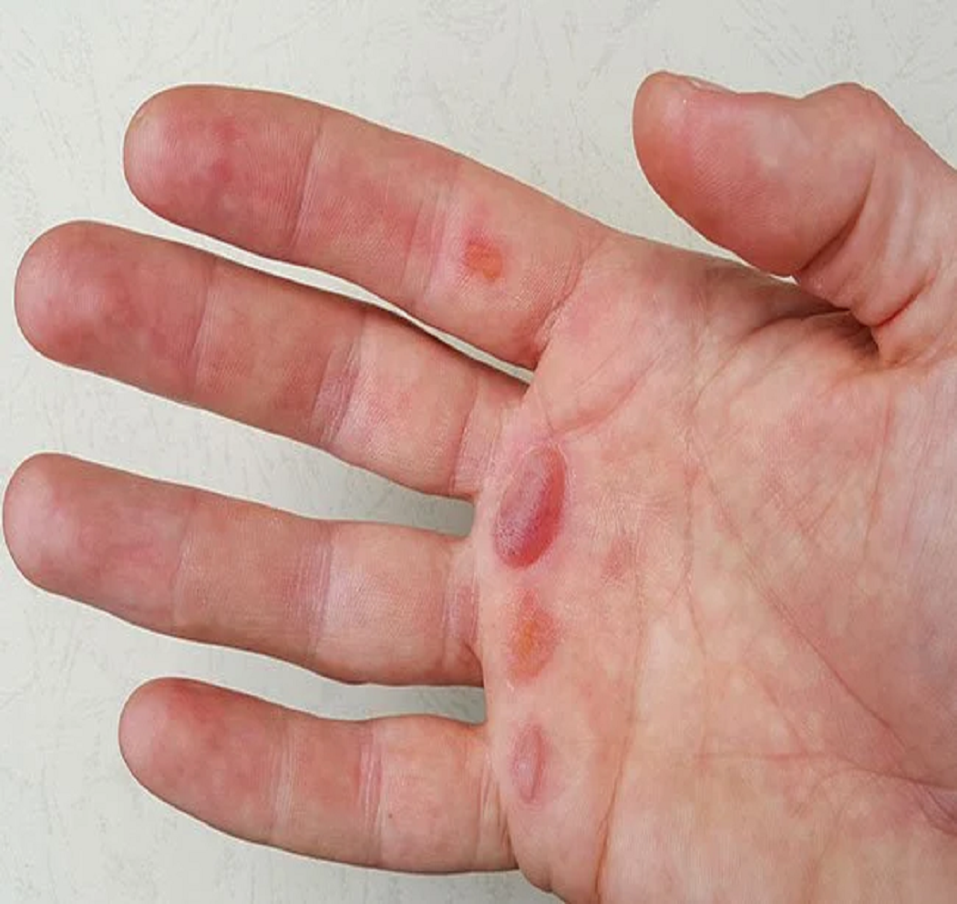 Homemade Remedies To Cure Blood Blisters